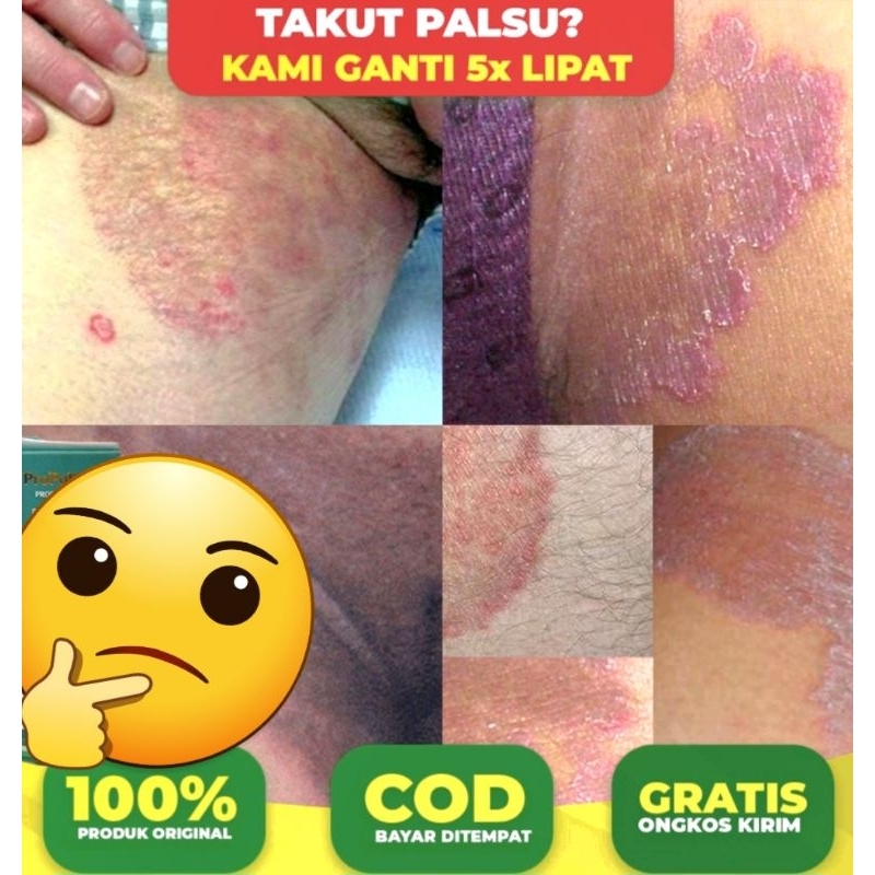 Obat Gatal Selangkangan Yang Sudah Menahun / Salep Gatal Jamur / Salep Gatal Gatal DiSelangkangan La