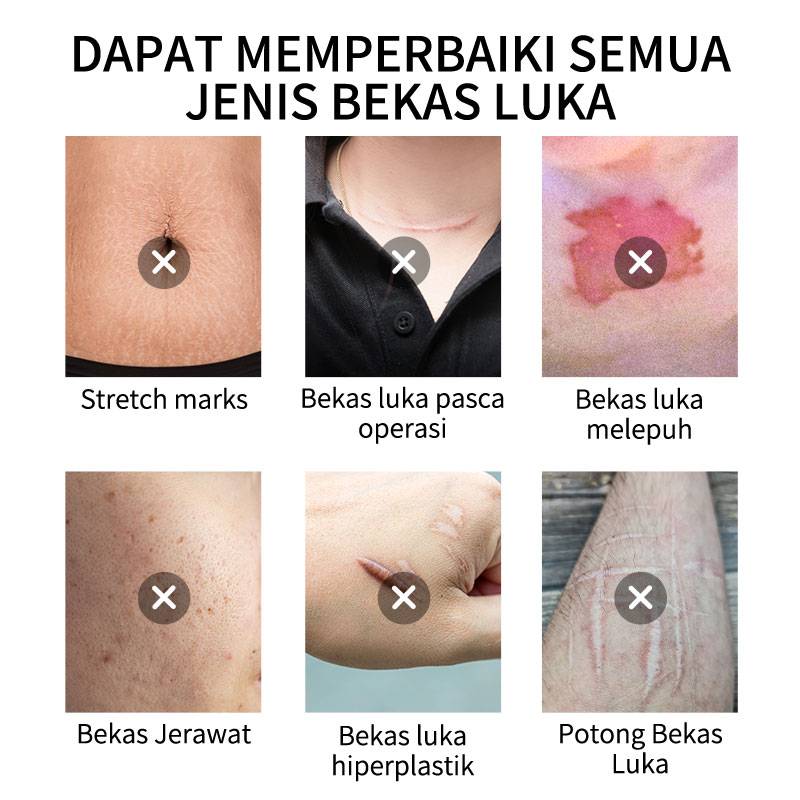 Gel menghilangkan bekas luka krim memudarkan bekas luka memperbaiki jerawat bekas luka lama bekas luka stretch mark bekas luka bakar 20g