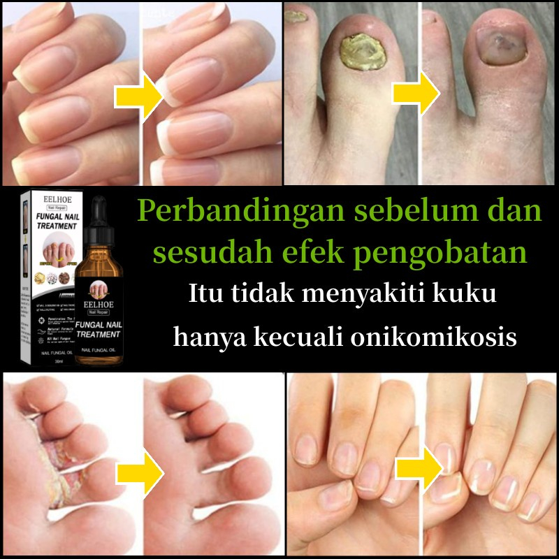 Obat Jamur Kuku Obat kuku jamur dan rusak Perawatan Kuku Berjamur Antibakteri Perawatan Kuku Onikomikosis Paronychia Anti Infeksi Kuku Toe Nail Pengobatan Jamur Minyak Nail Repair Essence Serum