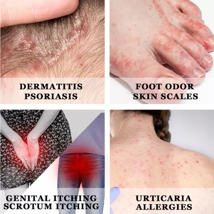 Obat Salep Gatal Salep Eksim Kering Paling Ampuh 20g Psoriasis Paling Ampuh Salep Kulit Gatal Dermatitis Jamur Anti Gatal Cream Bantuan Gatal Cepat Krim Psoriasis Eksim Original 100%