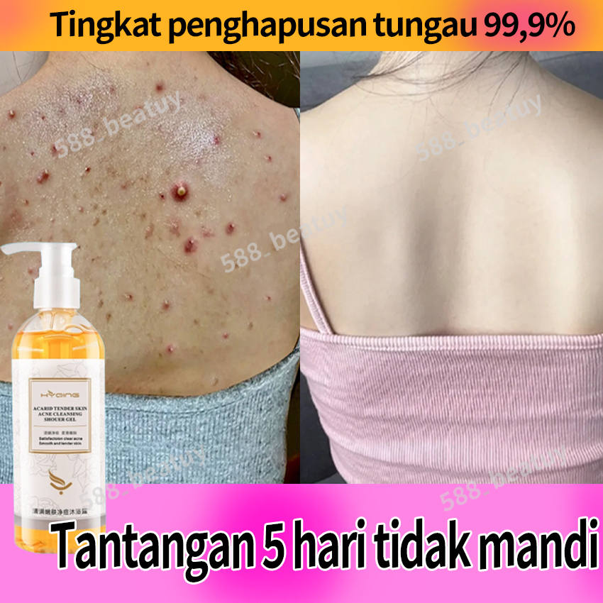 Sabun jerawat punggung Sabun jerawat Acne body wash Sabun mandi jerawat punggung Sabun penghilang je