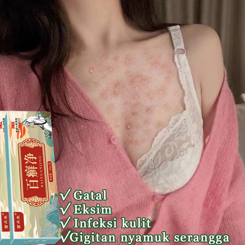 Obat Gatal Salep Obat Gatal Kulit Krim Gatal 20ml Salep antibiotik psoriasis antibakteri gatal krim krim dermatitis dan psoriasis psoriasis eksim eksim antid gatal salep