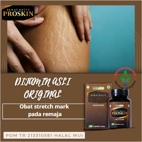 Obat stretch mark pada remaja - Herbal Penghilang Garis-garis putih, Stretch mark, striae, Selulit d