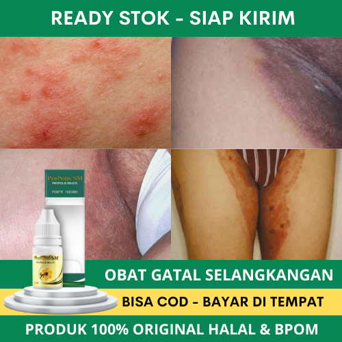 Obat Selangkangan Hitam, Obat Gatal Selangkangan, Obat Pembersih Jamur di Selangkangan, Obat Babak S
