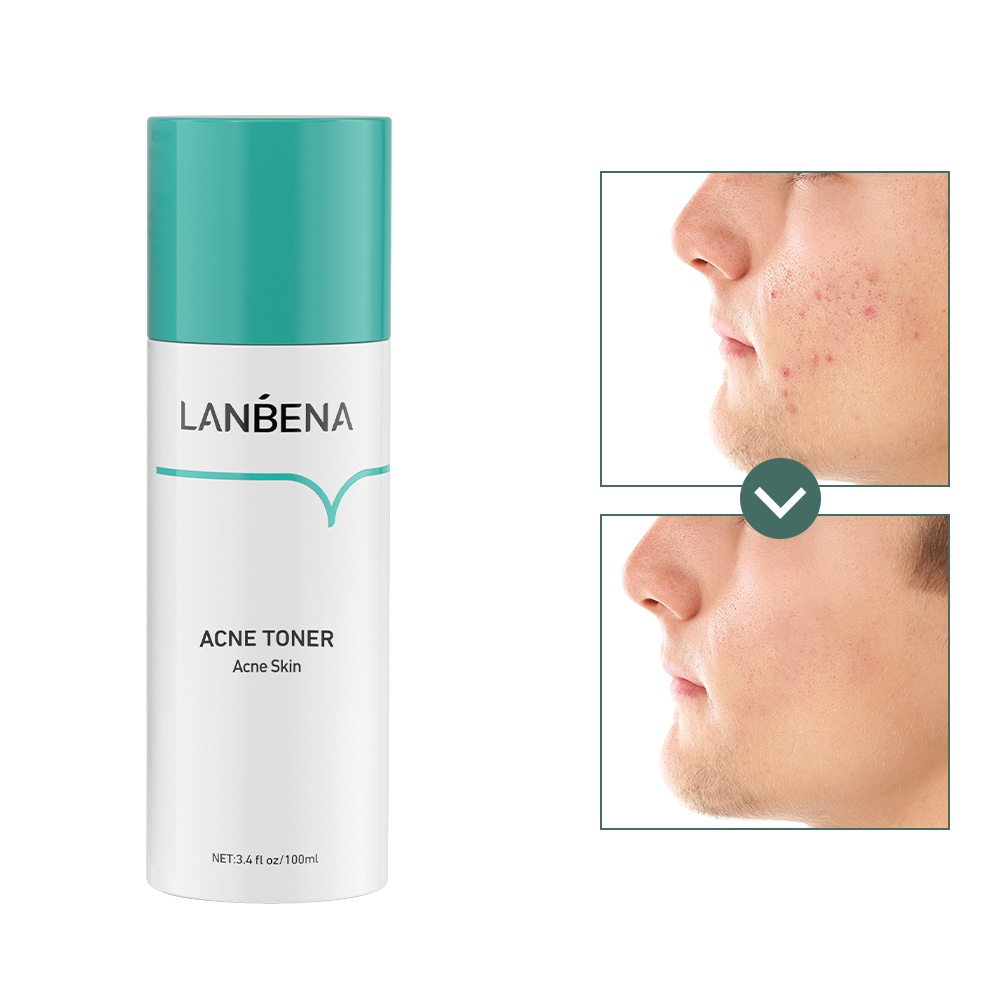 ✨ AKU MURAH ✨ LANBENA Acne Facial Treatment Toner 100 ML