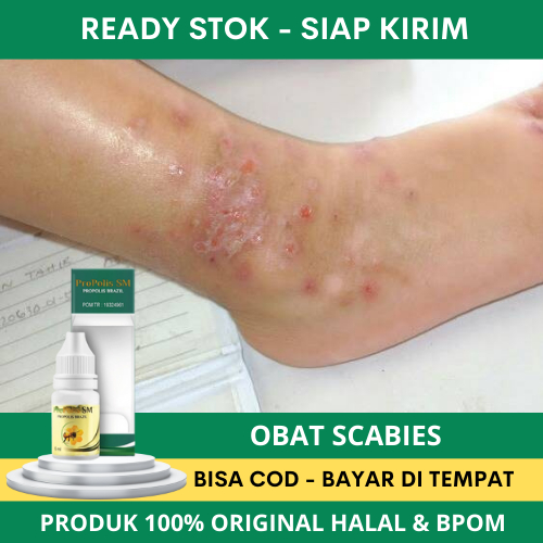 Obat Gatal Scabies, Obat Penghilang Scabies, Obat Gatal Kulit Scabies Manusia, Obat Gatal Gatal Scab