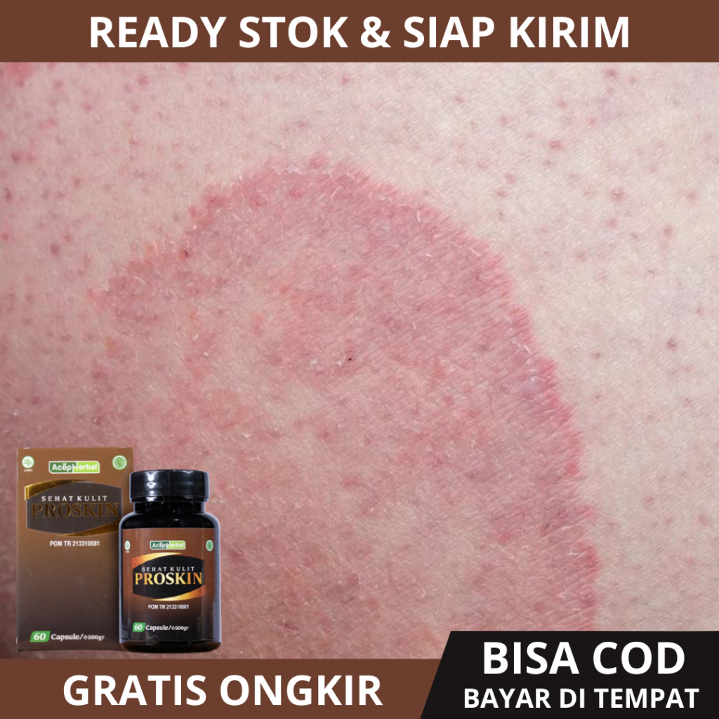 Obat Selangkangan Hitam, Obat Gatal Selangkangan, Obat Selangkangan Berjamur, Obat Eksim Selangkanga