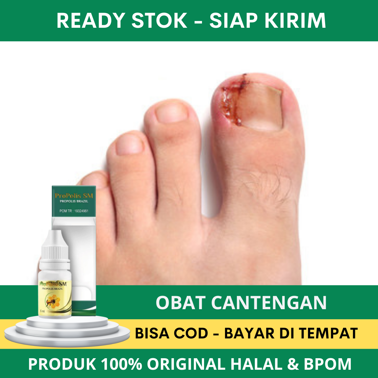 Obat Cantengan, Obat Cantengan Jempol Kaki, Obat Cantengan Tangan, Obat Cantengan Parah, Obat Canten