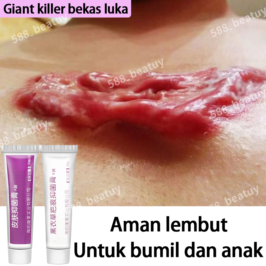Penghilang Bekas Luka Obat Herbal Oles Untuk Menghilangkan Bekas Luka Kering Ampuh Dijamin Penghilan
