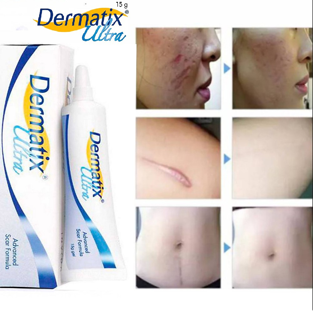 Dermatix Ultra Gel Advanced Scar Formula 15gr Salep Penghilang Bekas Luka/Dermatix Penghilang Bekas Luka/Scar Removal Cream