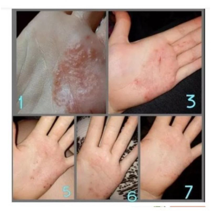 Zudaifu Salep Herbal 100% [𝐎𝐑𝐈𝐆𝐈𝐍𝐀𝐋] Salep Gatal Paling Ampuh Berkhasiat Obat Dermatitis Psoriasis Eksim Panu Jamur Kurap Kudis Alergi Kulit Selangkangan Jerawat Kutu Air Beri beri