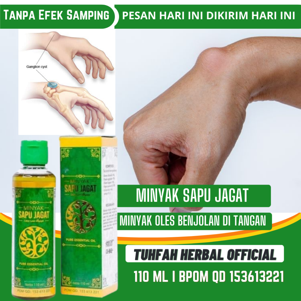 Minyak Oles Benjolan di Tangan, Obat Kista Ganglion, Benjolan Di Pergelangan Tangan, Mengecilkan Kis