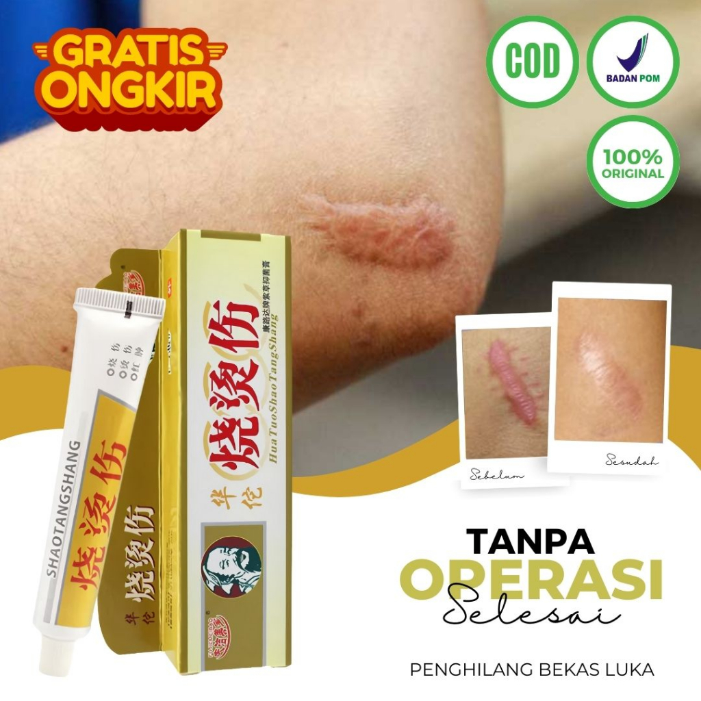 Obat Penghilang Bekas Luka Knalpot Salep Shao Tang Sang Penghilang Bekas Luka Koreng Hitam Gatal Kri