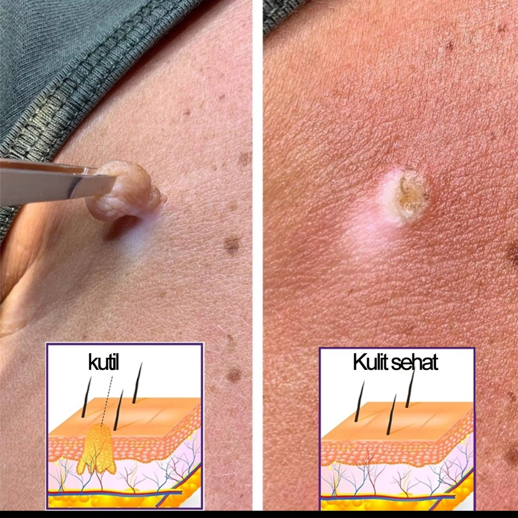 Krim kutil obat penghilang kutil penghilang kutil 20g skin tag remover Menghilangkan kutil, tahi lalat, berbagai skin tag di berbagai bagian tubuh