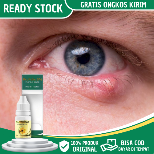 Obat Benjolan Di Kelopak Mata, Obat Oles Benjolan Di Kelopak Mata, Obat Benjolan Kelopak Mata, Obat 