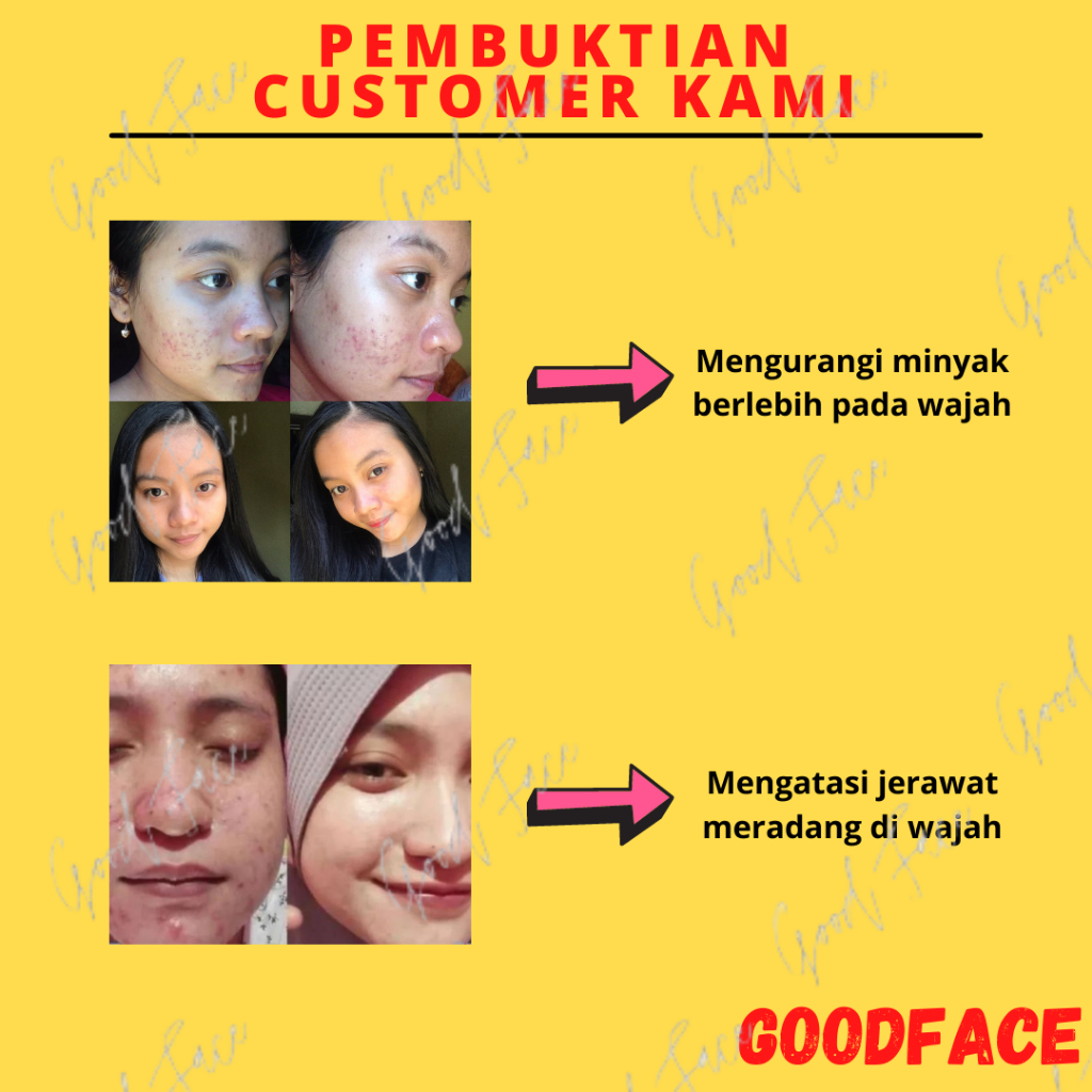 SERUM JERAWAT BREYLEE &amp; Gel Treatment - Perawatan Wajah Berjerawat 2 pcs