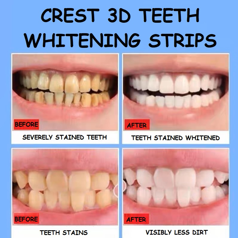 LUCKYMALL CREST 3D PEMUTIH 2 strip/pcs Strip Gel Gigi Whitening Teeth 1 atas 1 bawah 1 SACHET 2 Warna Putih Kebersihan Mulut Hyqiene White