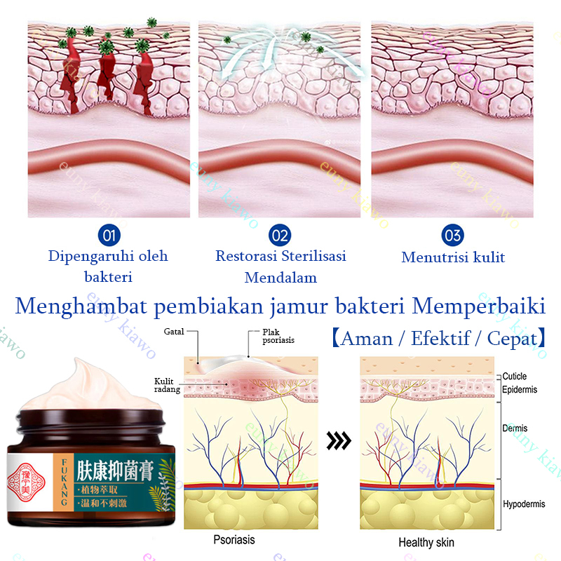 Obat Gatal Salep gatal Salep eksim Obat psoriasis Salep psoriasis 30G 【100% Original】Salep Kulit Jamur Dermatitis Psoriasis Eksim Jamur Kurap Alergi Kulit Cream Obat Gatal