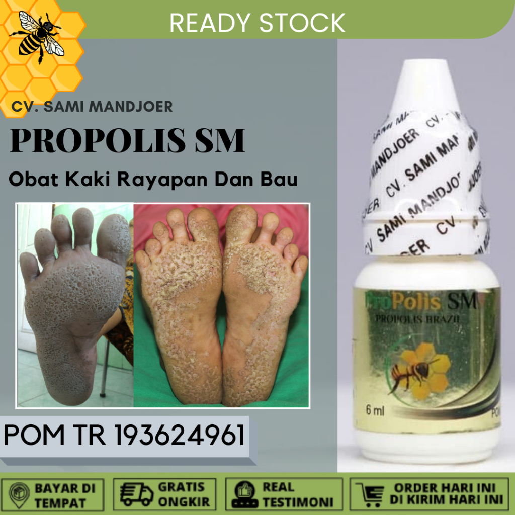 Obat Kaki Rayapan dan Bau Telapak Kaki Bolong Bolong Tumit Kaki Pecah-Pecah Propolis SM Original