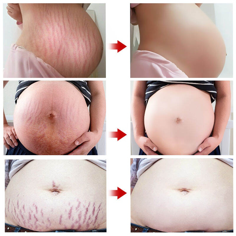 Stretch Mark Cream Anti- Stretch Mark Cream Krim Penghilang Strechmark Pasca Melahirkan Penghilang Bekas Luka 60g [100% Original]