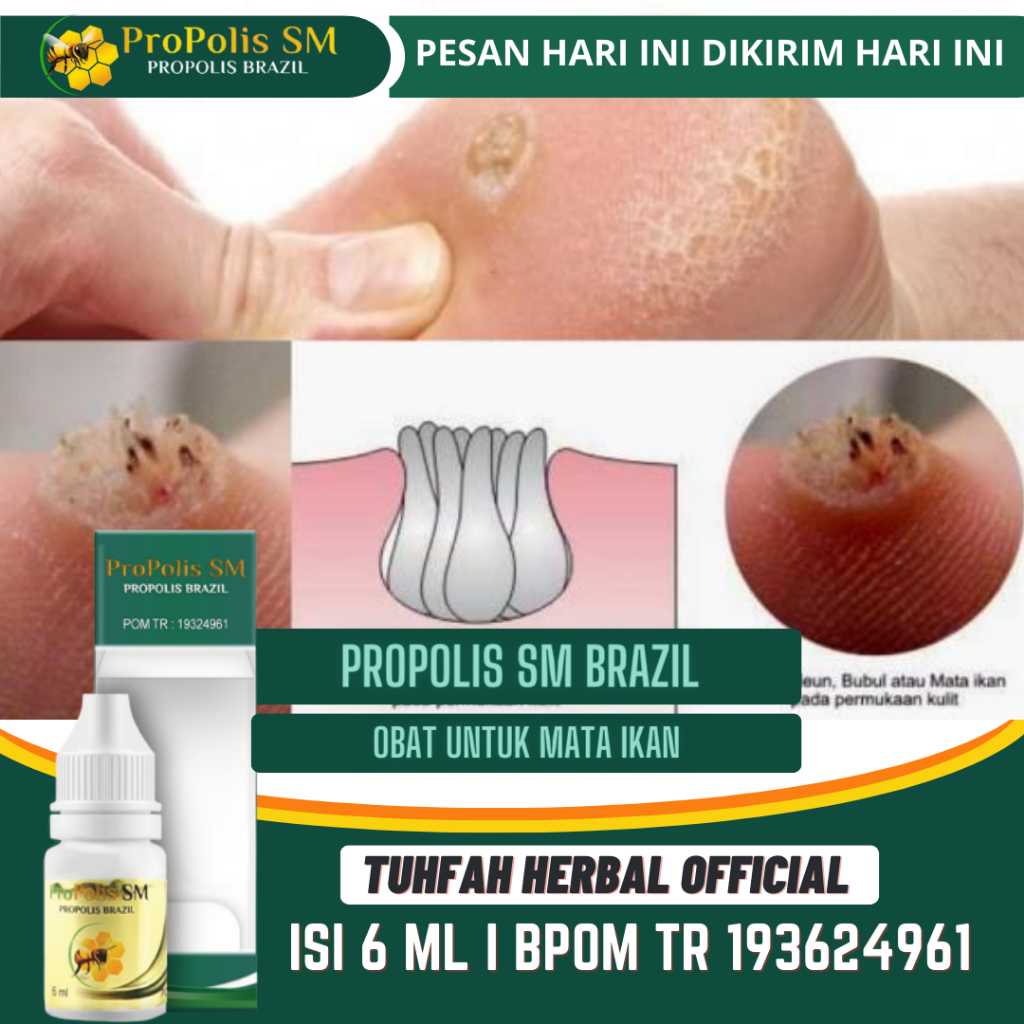 Obat Mata Ikan di Kaki, Mata Ikan di Tangan, Obat Mata Kaki Hitam, Hilangkan Mata Ikan Di Telapak Ka