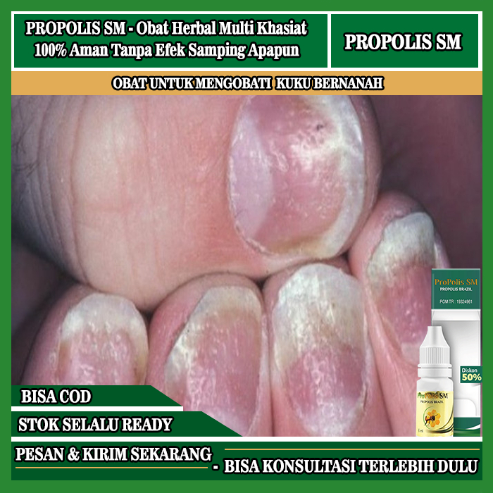 Obat Penghilang Jamur Kuku, Obat Kuku Infeksi Bernanah, Obat Kuku Rusak Berjamur, Obat Infeksi Kuku 