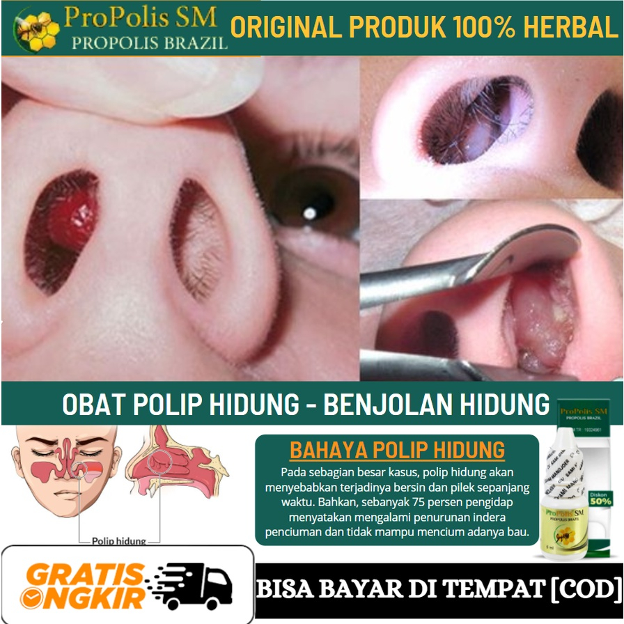 Obat Benjolan Dalam Hidung, Pengecil Benjolan Yang Menghambat Pernapasan, Polip Hidung, Propolis SM