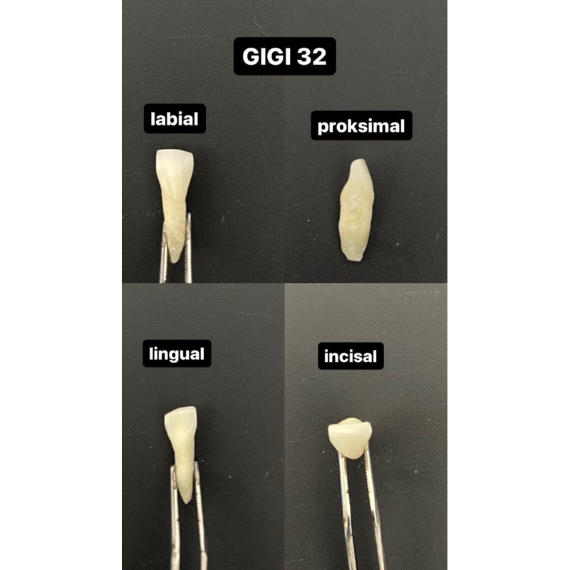 Gigi anterior Rahang atas 32