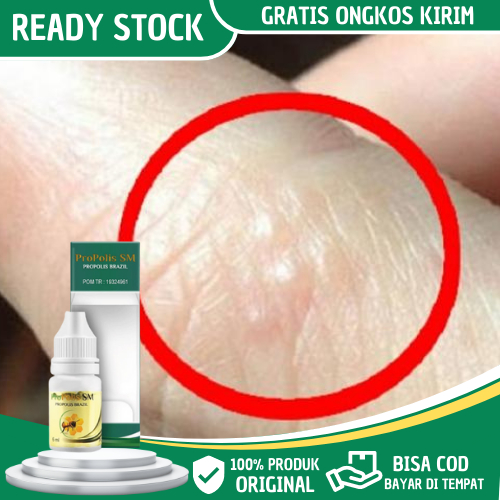 Obat Gatal Berair Di Jari Tangan, Obat Bintik Bening Berair Di Tangan, Obat Gatal Berair Pada Jari T