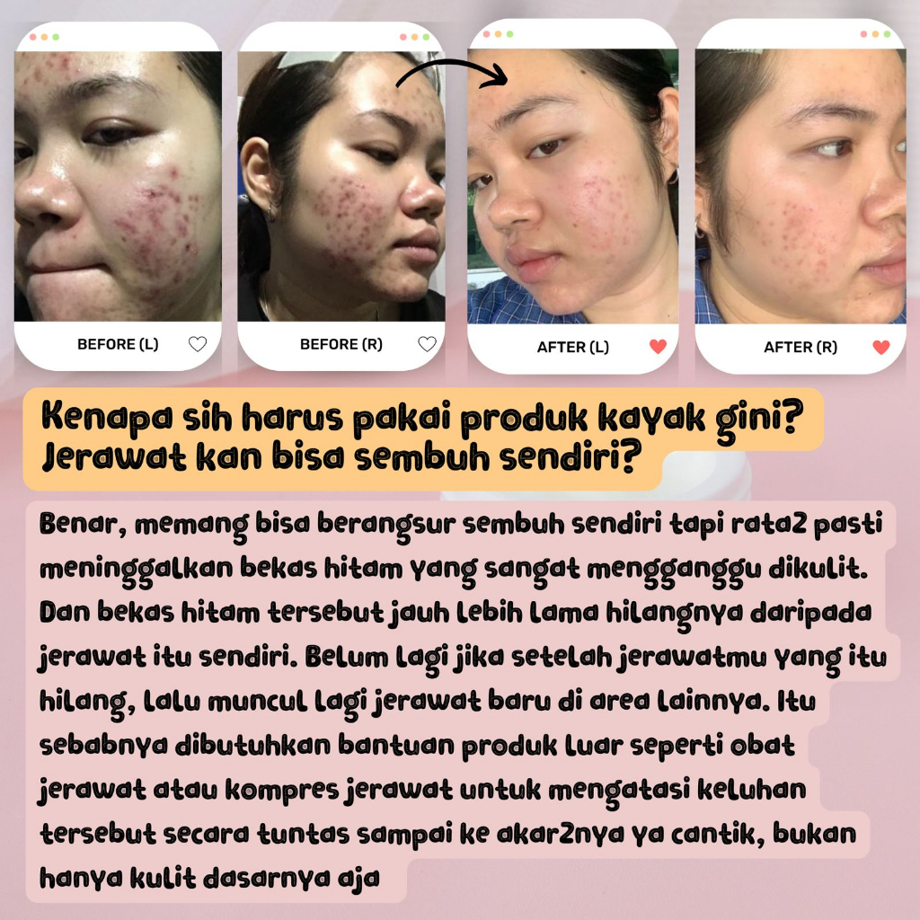 KOMPRES JERAWAT &amp; BRUNTUSAN - KRIM BEKAS JERAWAT - Cream Bopeng - Salep Jerawat - Obat Jerawat by WAZATARU