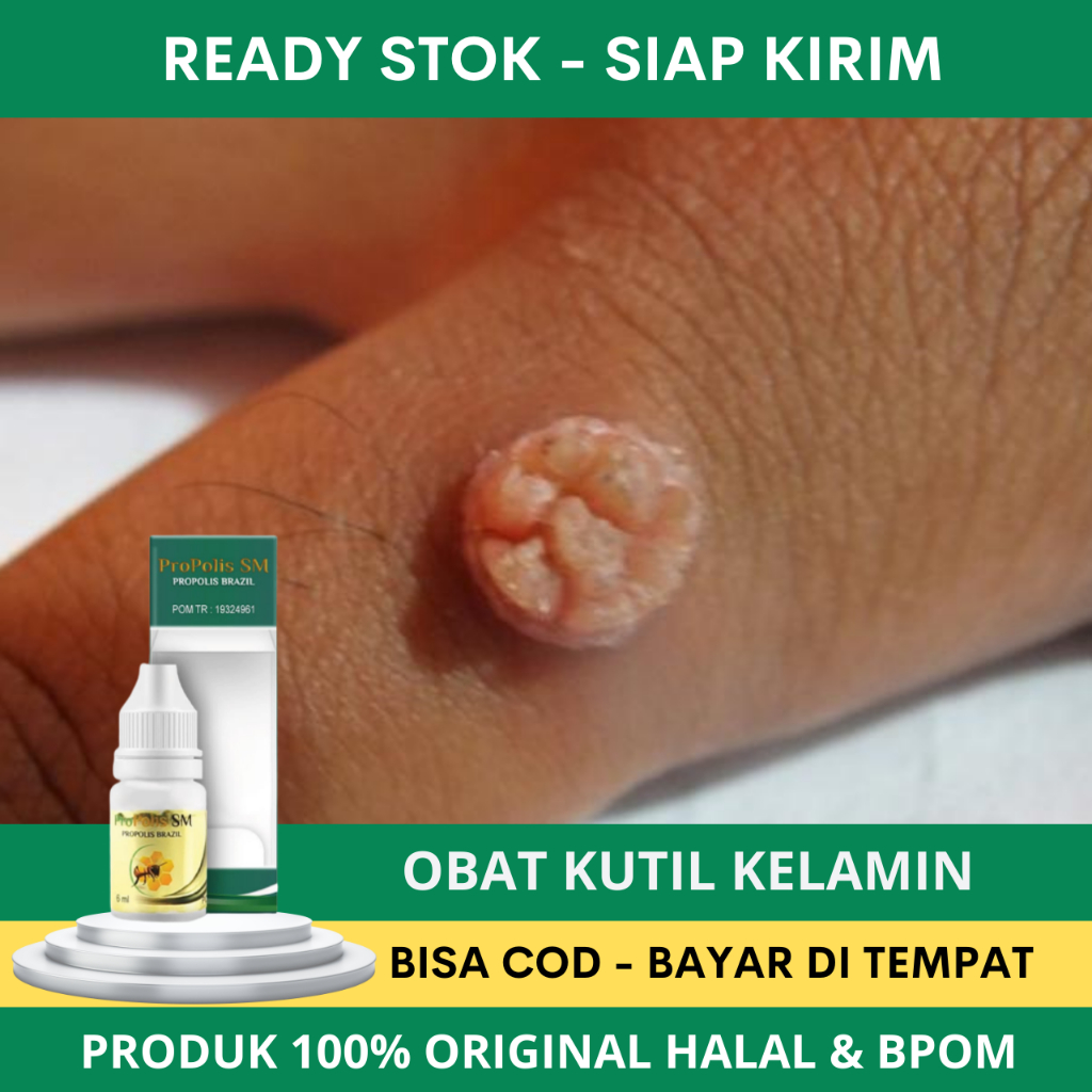 Obat Kutil Kelamin HPV, Obat Kutil Kelamin Pria, Obat Kutil Kelamin Wanita, Salep Kutil Kelamin Pria