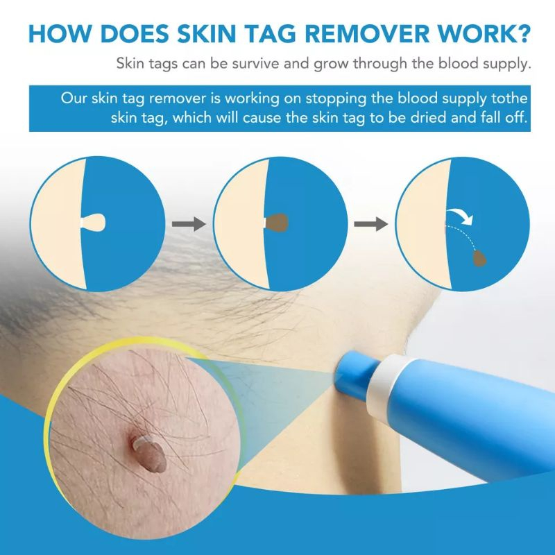 MAANGE Kit Penghilang Tag Kulit 2 in 1 Otomatis Perangkat Penghilang Tag Kulit Mikro Penghapus Kutil Noda Tahi Lalat Dewasa Set Perawatan Wajah Pena Perawatan Kulit Skin Tag Mole Removal Kit 1333