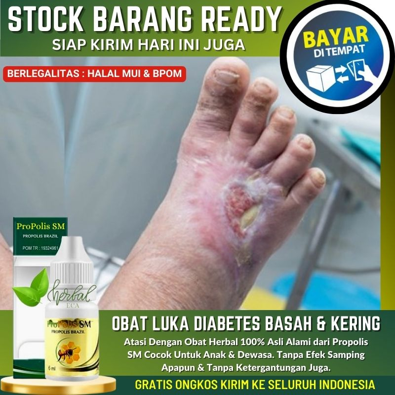 Obat Pengering Luka Diabetes di Kaki, Luka Diabetes Bengkak, Penghilang Nyeri Luka Diabetes, Obat Lu