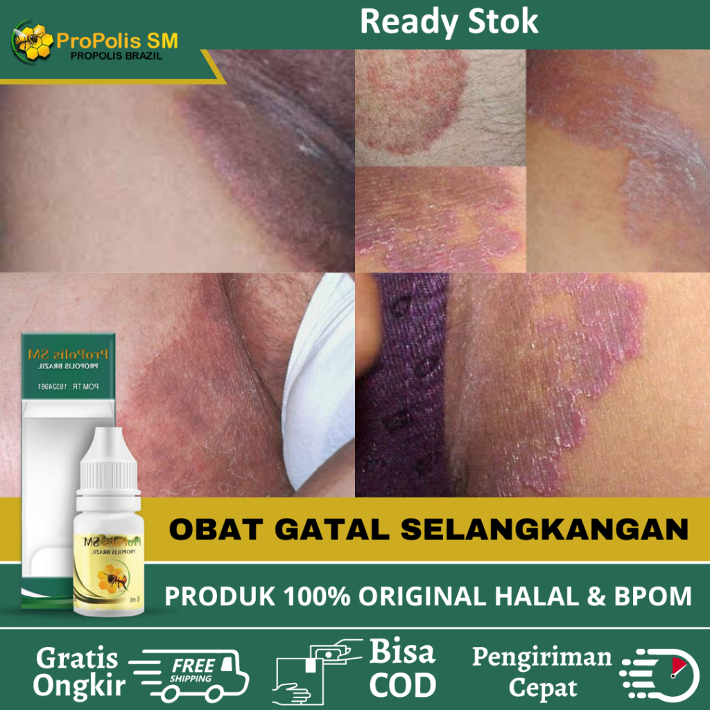 Obat Hitam Selangkangan, Obat Penghilang Selangkangan Hitam, Obat Gatal Selangkangan, Salep Gatal Se