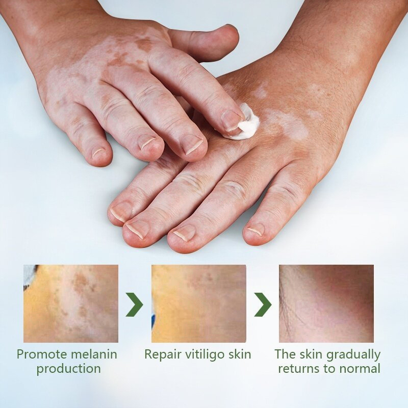 Salep vitiligo Obat vitiligo kulit bercak belang putih  panu, biang keringat salep panu anti bakteri dengan cepat musuh panu membantu pertumbuhan melanin krim penyamar noda obat salep khusus pemakaian vitiligo Salep obat luar utk vitiligo