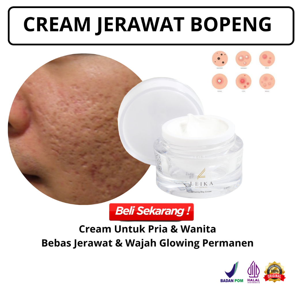 Ampuh Cream Jerawat Krim bekas jerawat  Penghilang Bekas Jerawat Pria Wanita Permanen Bpom Paling Am