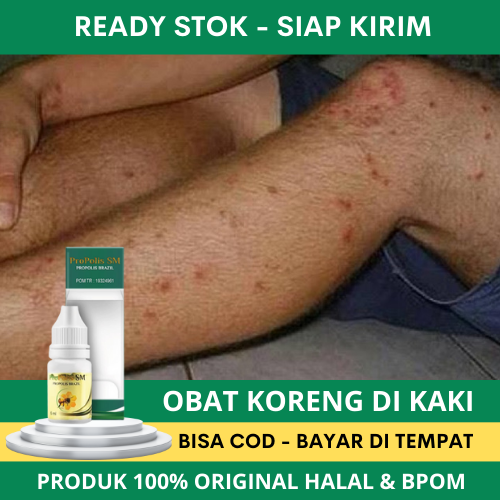 Obat Koreng di Kaki, Obat Koreng Bernanah Di Kaki, Korengan, Koreng Borok, Koreng Menahun, Koreng Ga