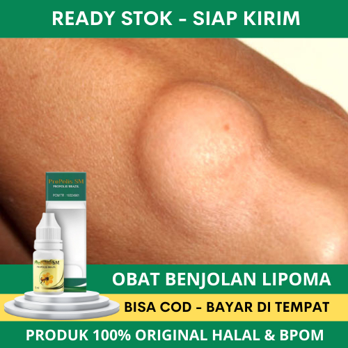 Obat Lipoma, Benjolan Lipoma, Penghancur Benjolan Lipoma, Obat Tetes Oles Lipoma Terlaris - Solusi P