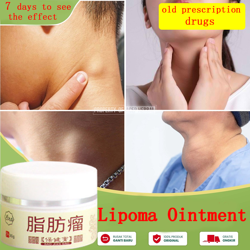 Obat Benjolan di Leher Obat benjolan Lipoma 30g Krim penghilang kista lemak (kista) Meredakan nyeri kista subkutan - Lipoma Removal Cream 100% Original