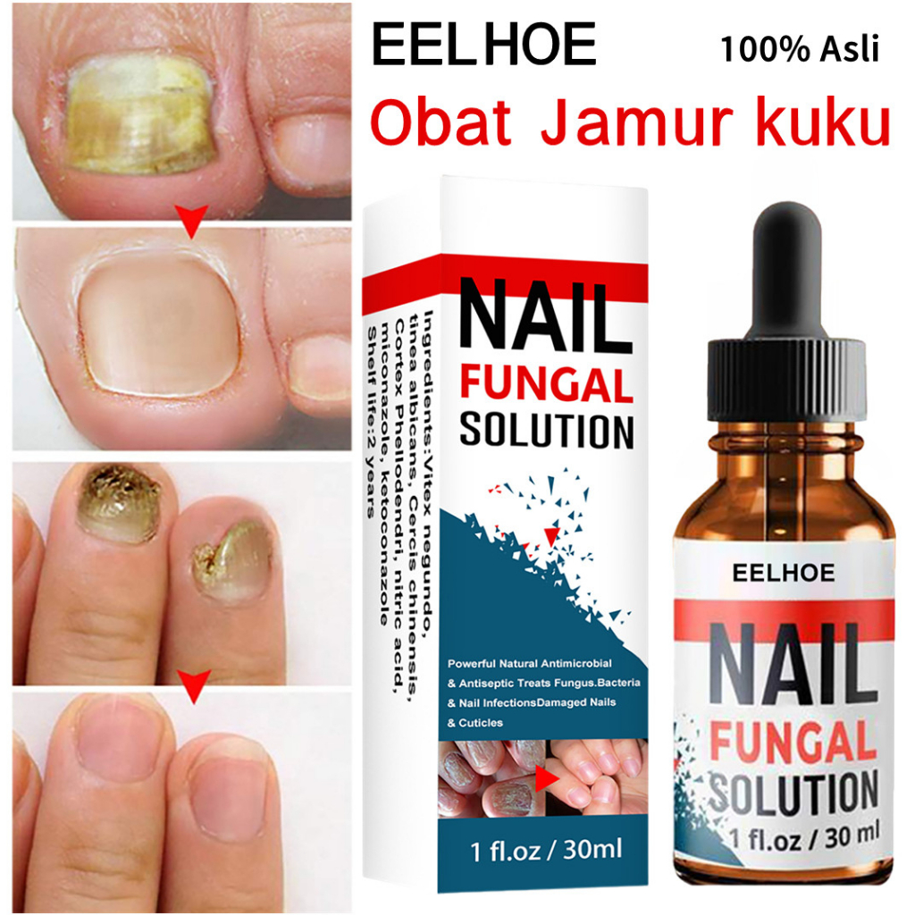 [100% Asli ] Obat Infeksi Jamur Kuku | Obat Anti Jamur Kuku | Serum Perawatan Perbaikan Kuku Rusak | Perawatan Infeksi Kuku | Obat Penghilang Jamur Kuku Bernanah 30ml