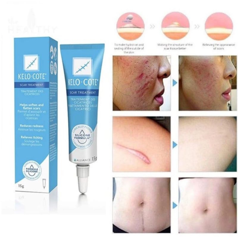RtopR SCAR CREAM | KELO COTE SCAR CREAM PENGHILANG BEKAS LUKA