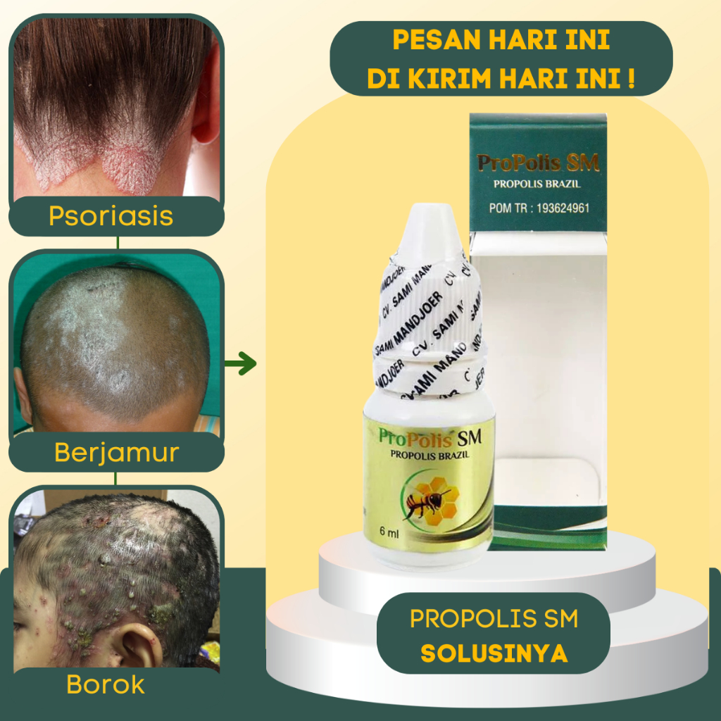 Obat Gatal Kulit Kepala, Obat Psoriasis Kulit Kepala Gatal Berkerak, Kulit Kepala Bersisik, Obat Jam