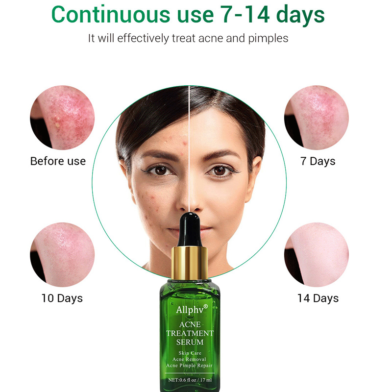 ALLPHV Anti Acne Serum Acne Spot Treatment - Serum Jerawat Dan Bekas Jerawat