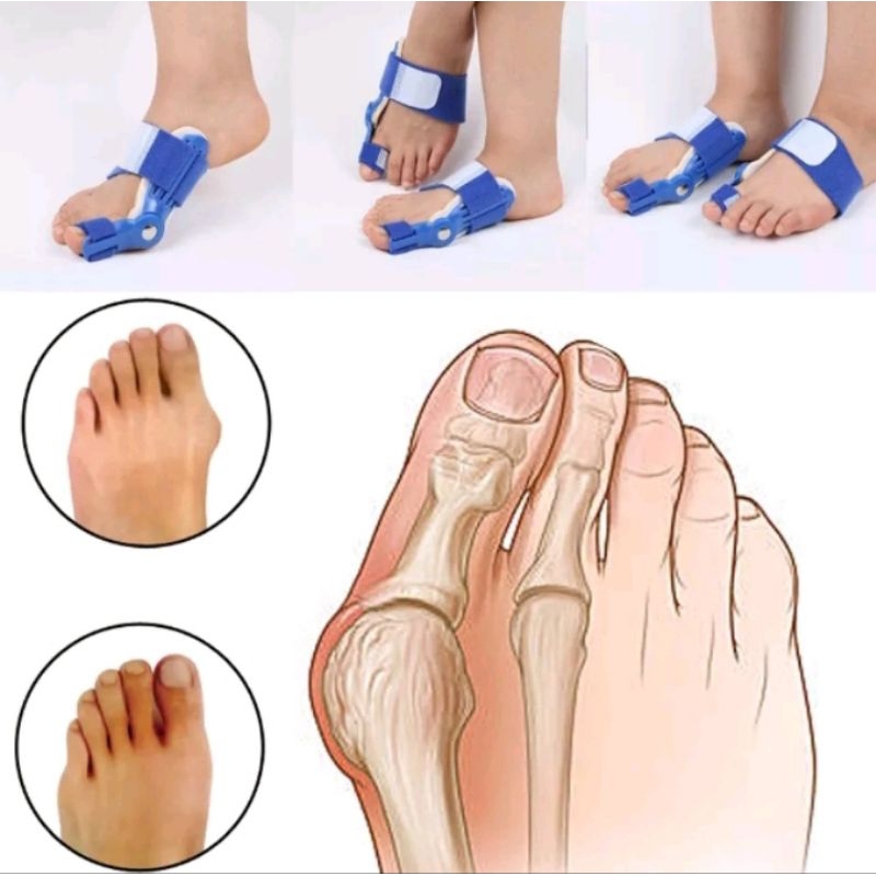 Alat Korektor pelurus penyangga tulang jempol jari kaki bunion terapi alat kesehatan