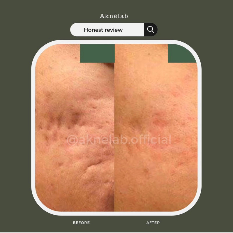 Rangkaian Bekas Jerawat &amp; Acne Scars Series Aknèlab (menghilangkan PIE PIH dan Bopeng sekaligus)