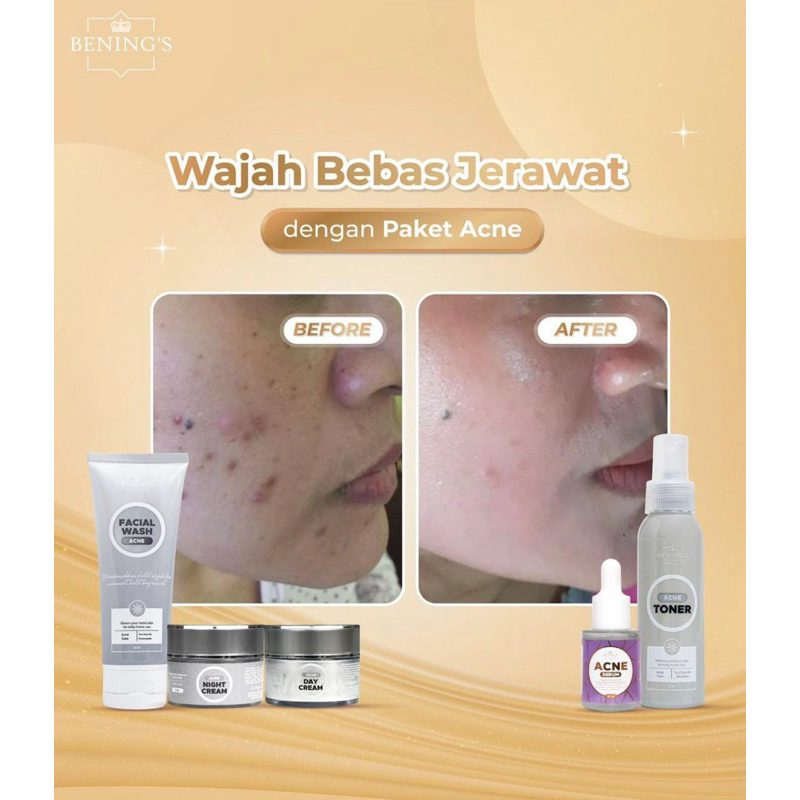 ACNE SKINCARE + SERUM ACNE SALE!! BENING’S dr. OKY PRATAMA (acne intensive care)