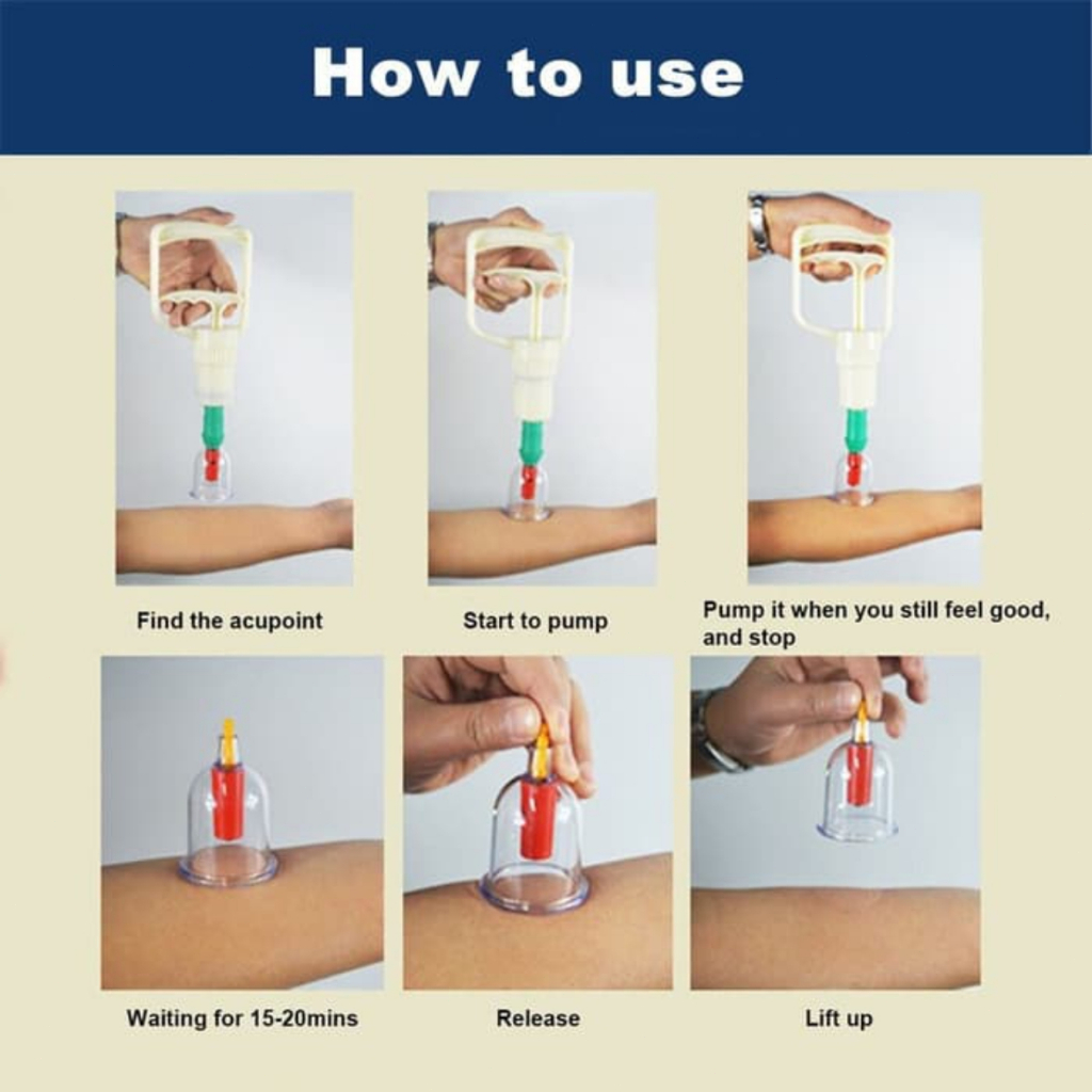 Kop Sedot Masuk Angin Alat Bekam Atasi Masuk Angin Merk Kop Angin Ada 6 Kop Yang Ukurannya Berbeda-beda