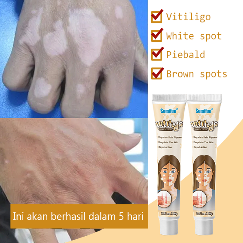 musuh panu, membantu pertumbuhan melanin, krim penyamar noda, obat salep khusus pemakaian vitiligo[1