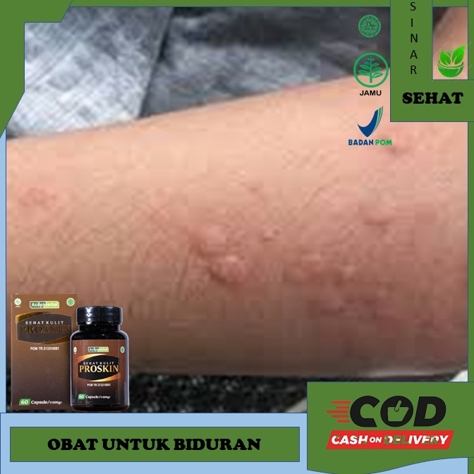 obat biduran obat biduran menahun Obat Biduran Obat Biduran Alergi Dingin Menahun Kronis Kaligata Un