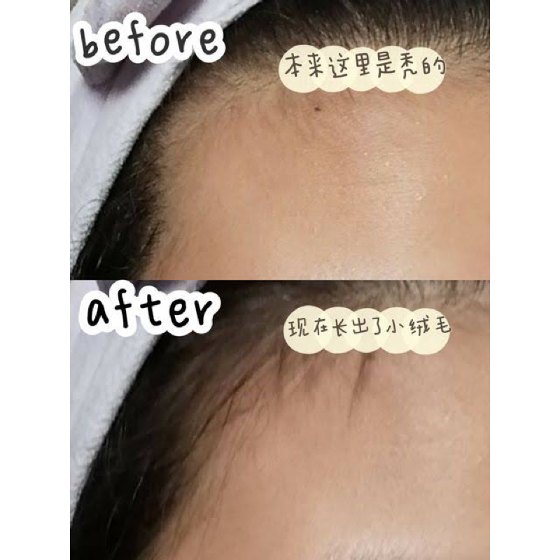 SERUM PENUMBUH RAMBUT DAN ANTI RONTOK JEPANG MENUMBUHKAN JUGA MELEBATKAN EFEKTIF DAN PASTI BERHASIL SERUM ALOPECIA SERUM SEBORRHEA